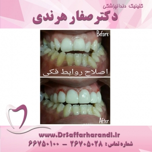 لامینیت دندان