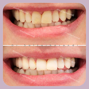 سفید کردن دندان-دکتر مجتبی هرندی