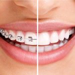 تفاوت ارتودنسی و لمینت