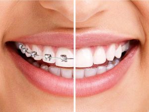 تفاوت ارتودنسی و لمینت