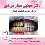 مزایا و معایب بلیچینگ دندان
