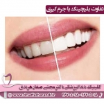 تفاوت بلیچینگ با جرم گیری دندان