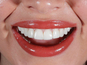 کامپوزیت دندان های جلو