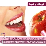 بلیچینگ یا لمینت