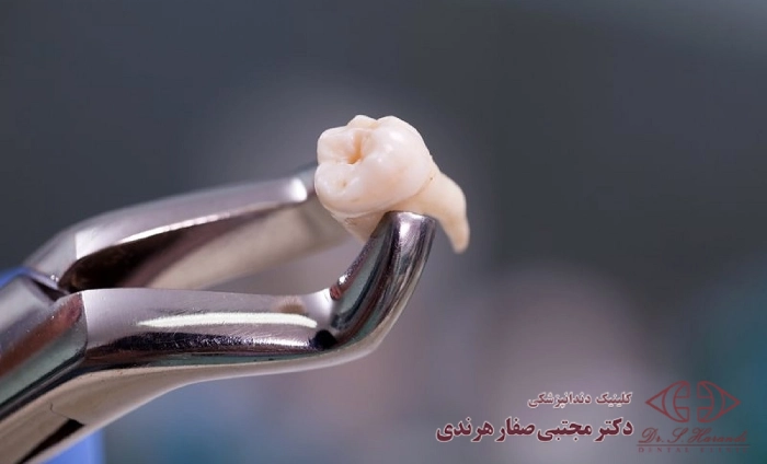 دلایل کشیدن دندان چیست؟