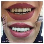 اصلاح طرح لبخند