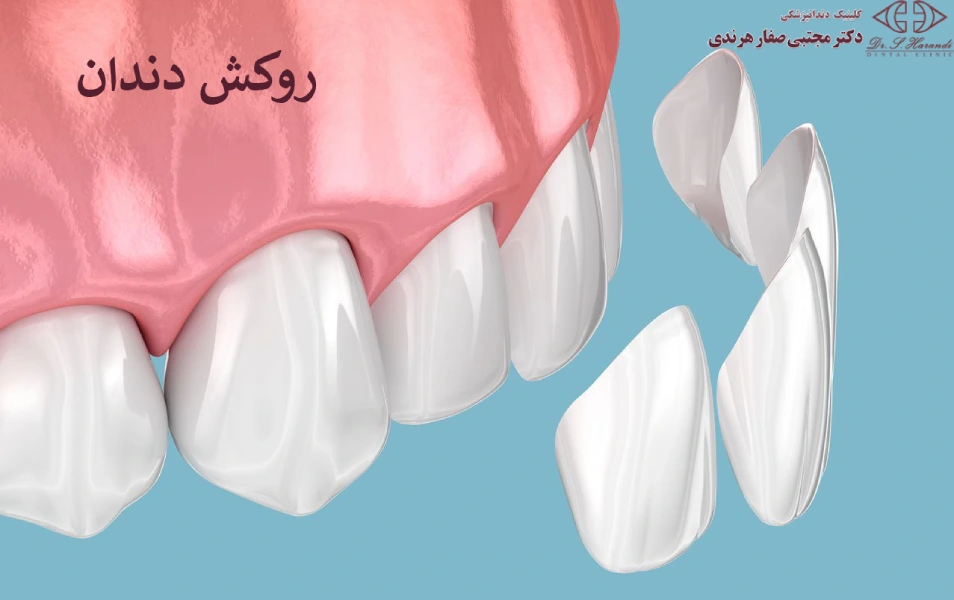 روکش دندان