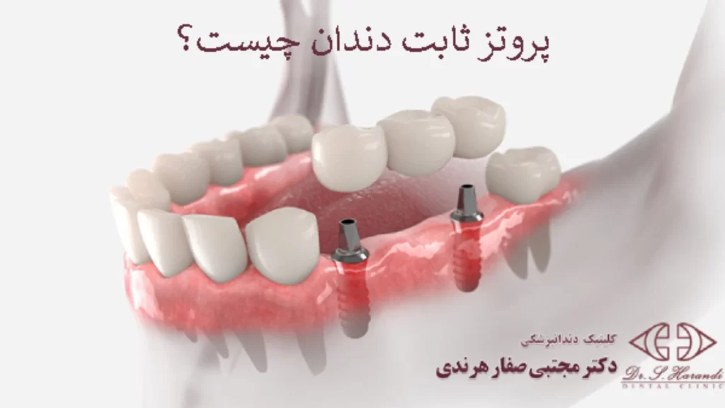 پروتز ثابت دندان