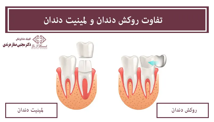 تفاوت روکش دندان و لمینیت دندان