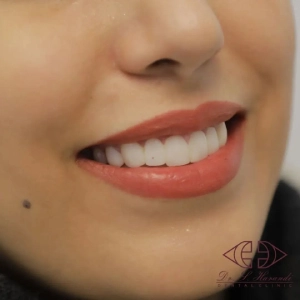 کامپوزیت دندان دکتر صفارهرندی