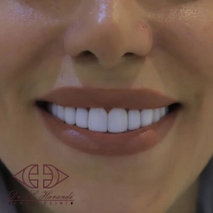 نمونه کامپوزیت دندان