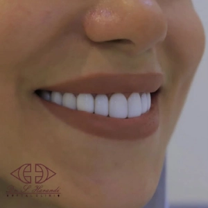 نمونه کار کامپوزیت دندان