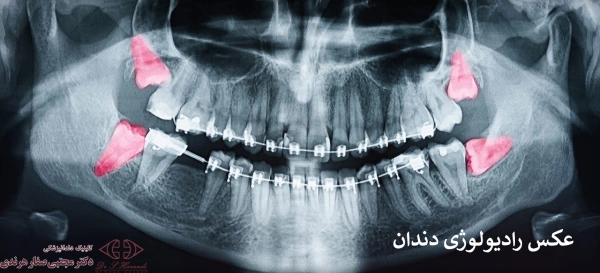عکس رادیولوژی
