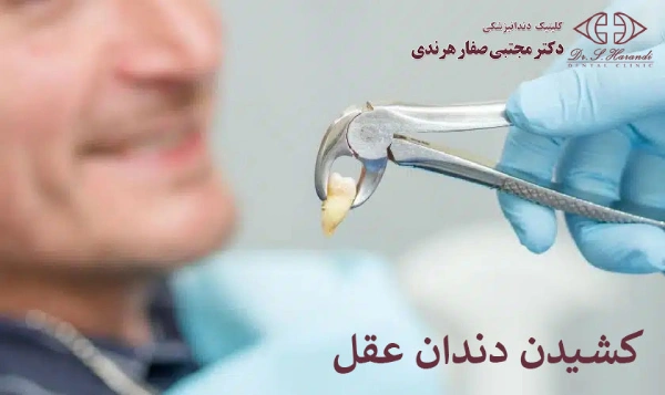 کشیدن دندان عقل 
