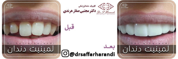 نمونه کار لمینت دکتر هرندی