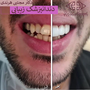 نمونه کار کامپوزیت دندان