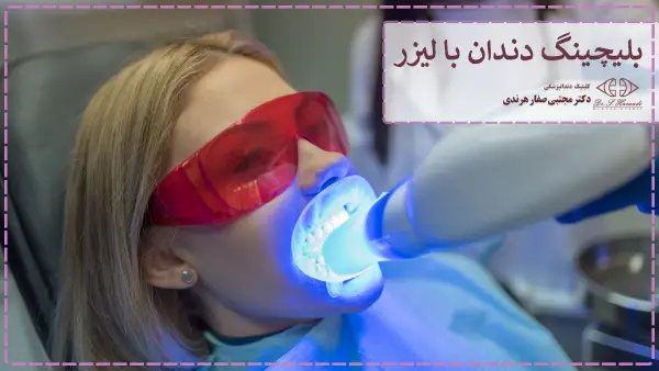 بلیچینگ دندان با لیزر