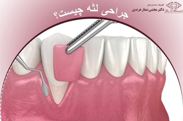 جراحی لثه چیست؟