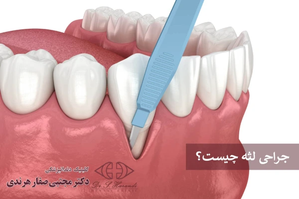 جراحی لثه چیست؟