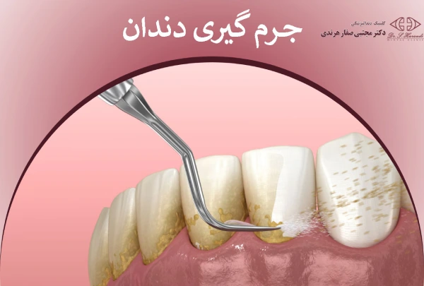 جرم گیری دندان