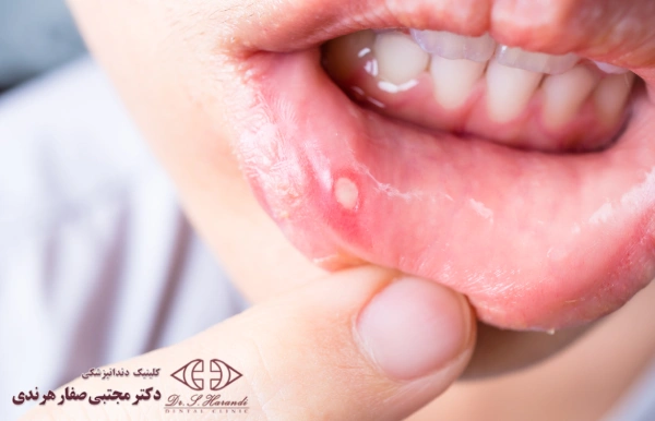 آفت دهان