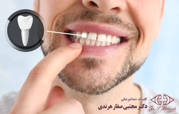 ساختار ایمپلنت دندان 