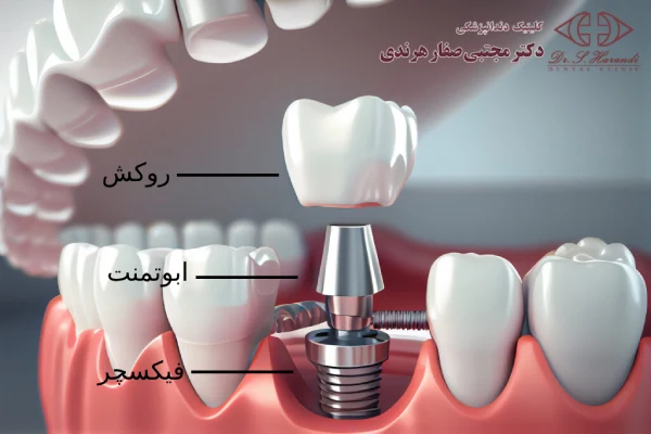 ساختار ایمپلنت دندان 