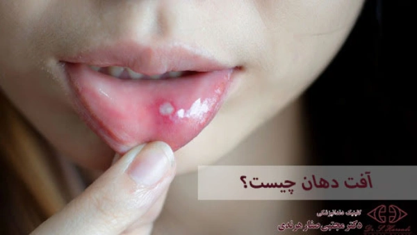 آفت دهان