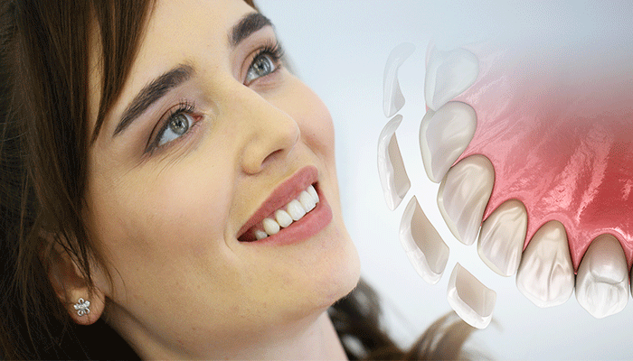 تفاوت لمینت و روکش دندان در چیست؟