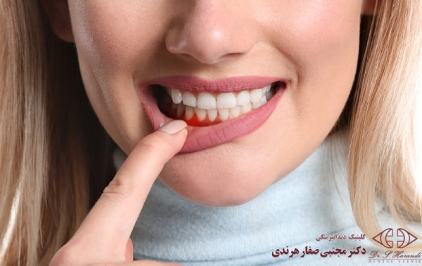 علت عوارض لمینت دندان