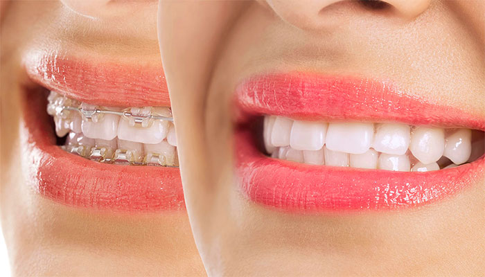 تفاوت ارتودنسی و لمینت چیست؟