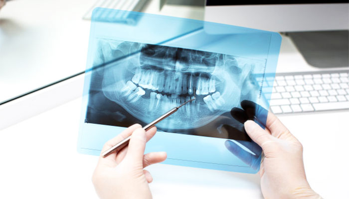 رادیوگرافی دندان چیست؟