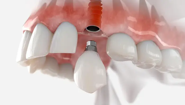 لق شدن ایمپلنت دندان چیست؟