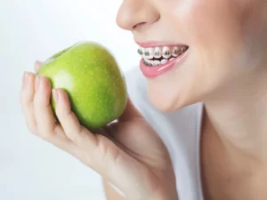 رژیم غذایی در ارتودنسی