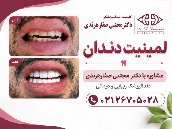 نمونه کارهای لمینت دندان