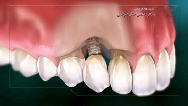 علت پس زدن ایمپلنت چیست؟