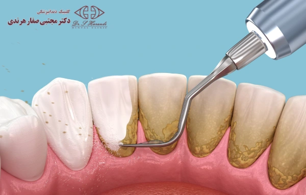 بهترین زمان برای جرم گیری دندان برای ارتودنسی