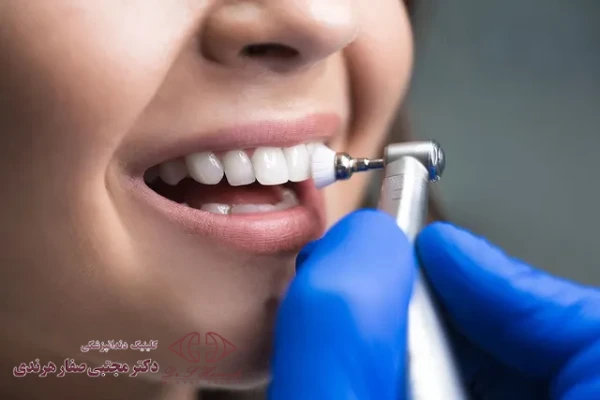 پالیش کردن دندان بعد از کامپوزیت