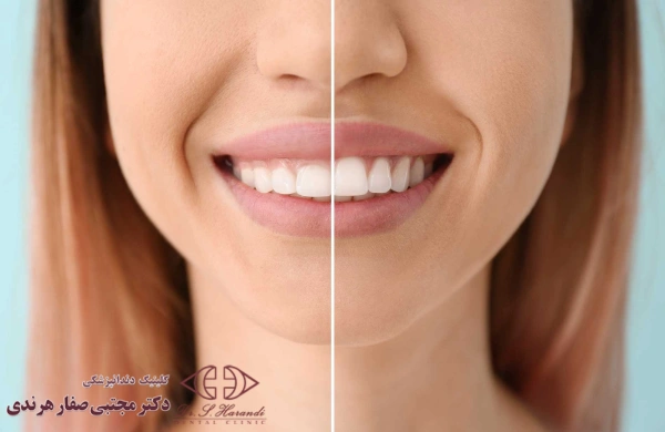 علت جراحی لثه برای کامپوزیت