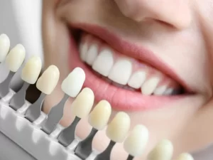 کامپوزیت دندان خرگوشی چگونه است؟