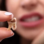  آیا کامپوزیت باعث پوسیدگی دندان می‌شود؟