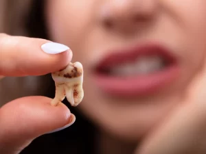  آیا کامپوزیت باعث پوسیدگی دندان می‌شود؟