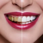 سفید کردن کامپوزیت دندان