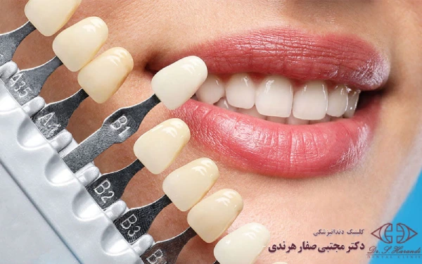 بلیچینگ بهتر است یا کامپوزیت؟