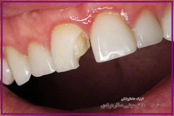لمینت دندان شکسته