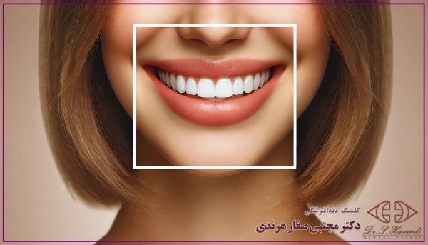 لمینت خرگوشی بهتر است یا کامپوزیت دندان خرگوشی؟