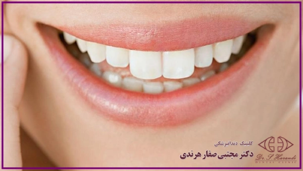 لمینت دندان خرگوشی