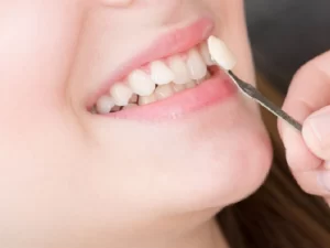 اصلاح طرح لبخند با لمینت دندان خرگوشی