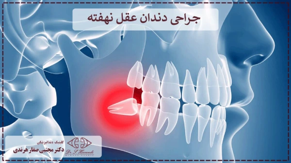 جراحی دندان عقل نهفته 