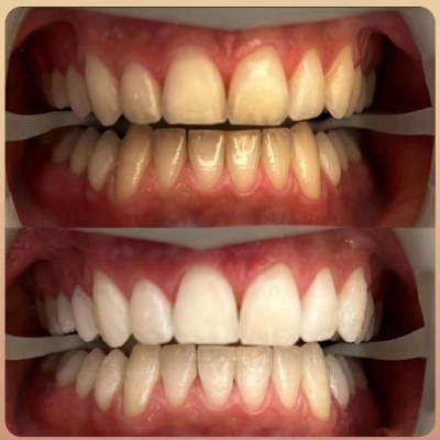 نمونه کار بلیچینگ دندان